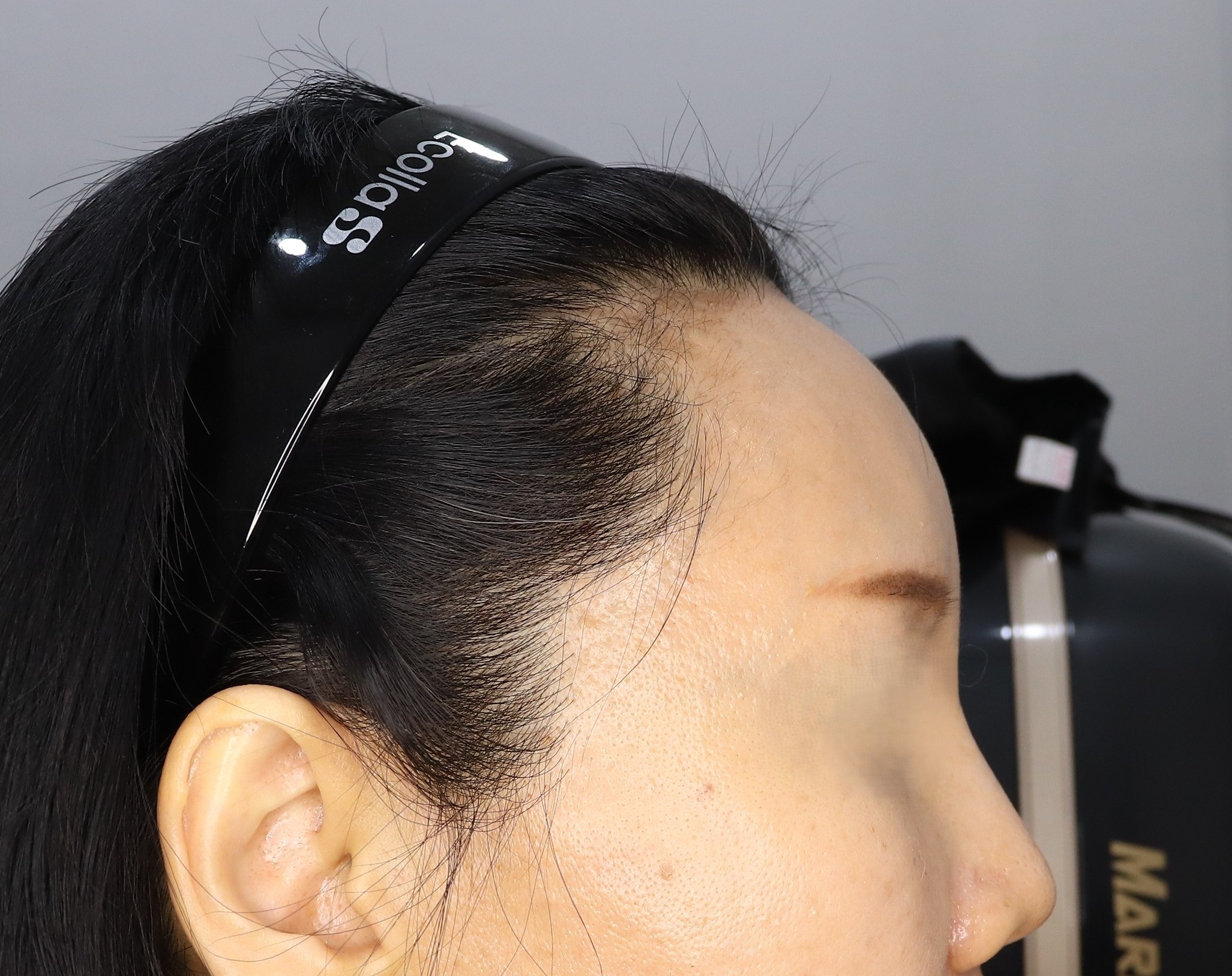 이마+ 관자필러 이마미간보톡스 후기