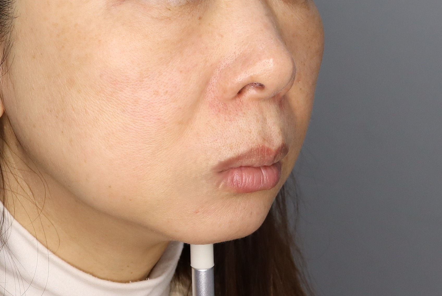 민트무제한실리프팅,무제한필러,턱끝필러 후기