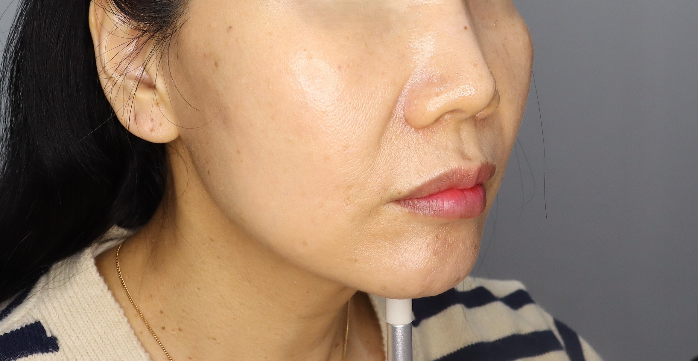 브이핏실리프팅+얼굴전체 볼륨필러 +러시안립필러