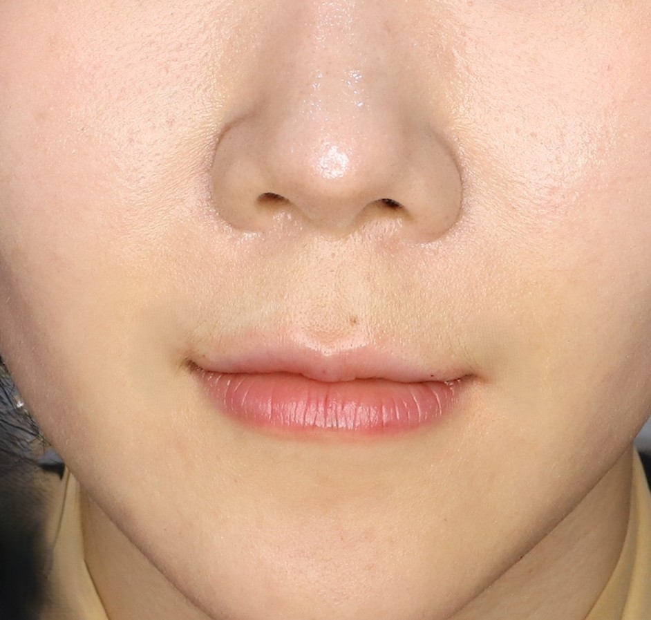 얇은 입술 볼륨 필러