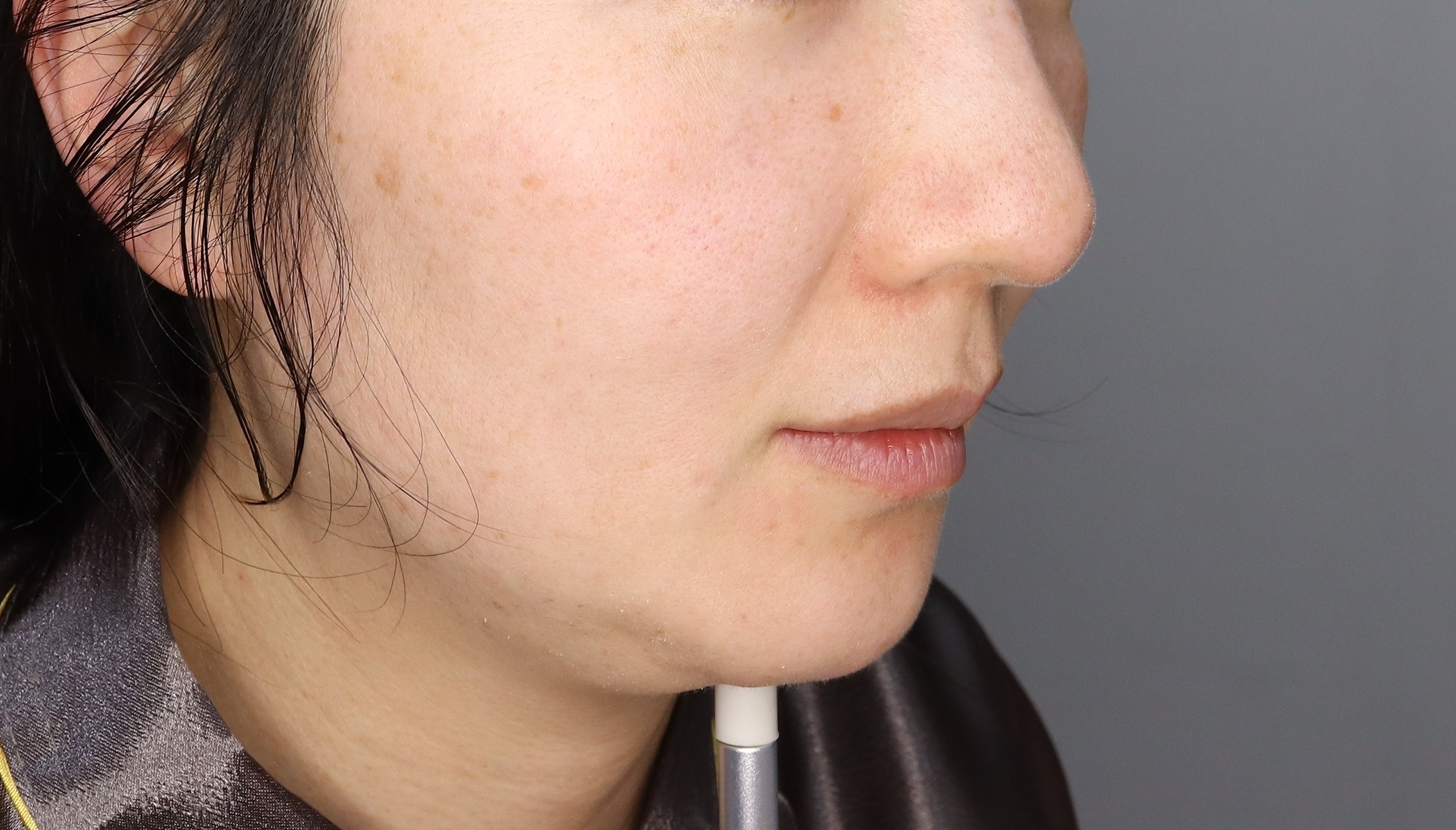 이중턱 민트 실리프팅, 러시안립필러 후기